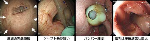 図１０・１ ワンステップボタンにて造設11日目にBBS発症。