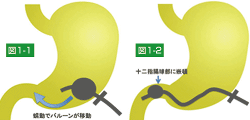 胃蠕動により幽門から十二指腸に排出され(図１-１)、十二指腸に嵌頓してしまう状態である(図１-２)