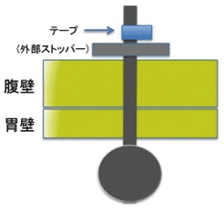 ボールバルブ症候群の予防