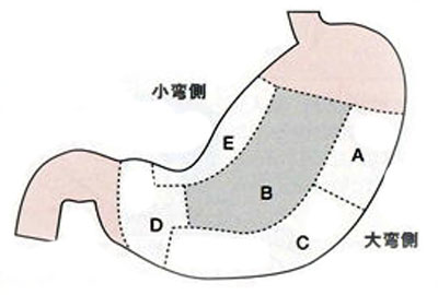 図１　造設部位による合併症の頻度2)