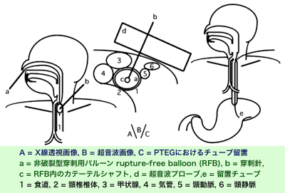 図１　PTEGの基本手技の模式図