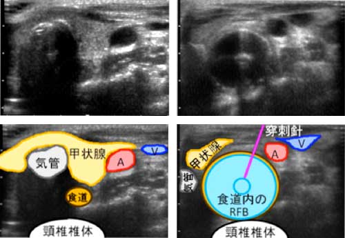 図２　左側頸部超音波画像10)