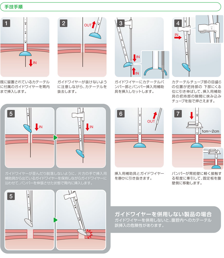 PEGソリッド。手動式圧調節装置。