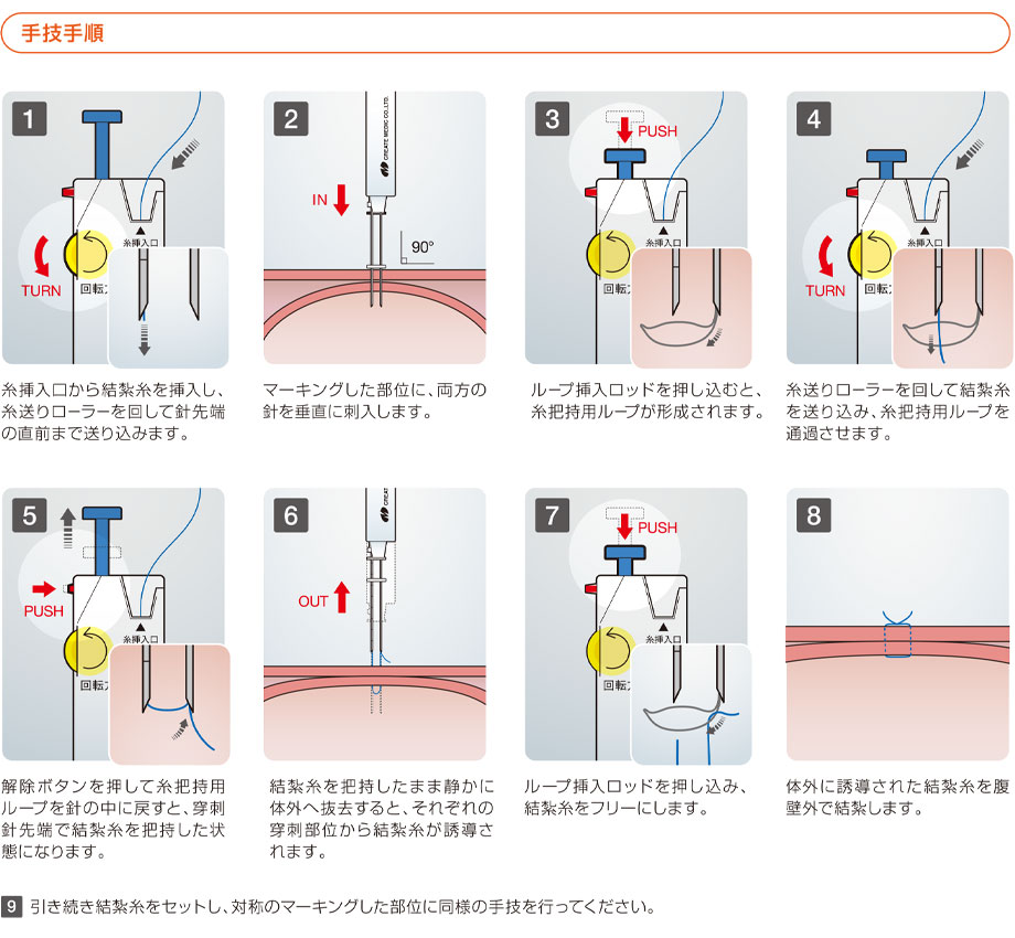 胃壁固定具Ⅱ（鮒田式胃壁固定具Ⅱ）の手技手順