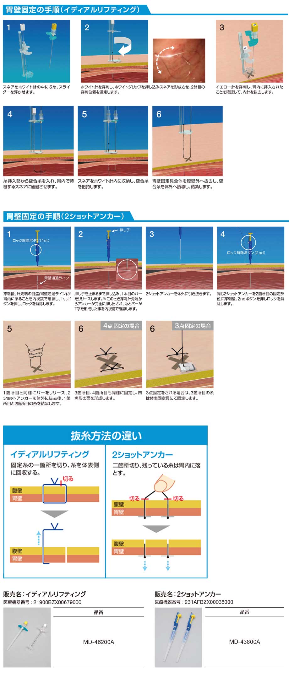 胃壁固定の手順