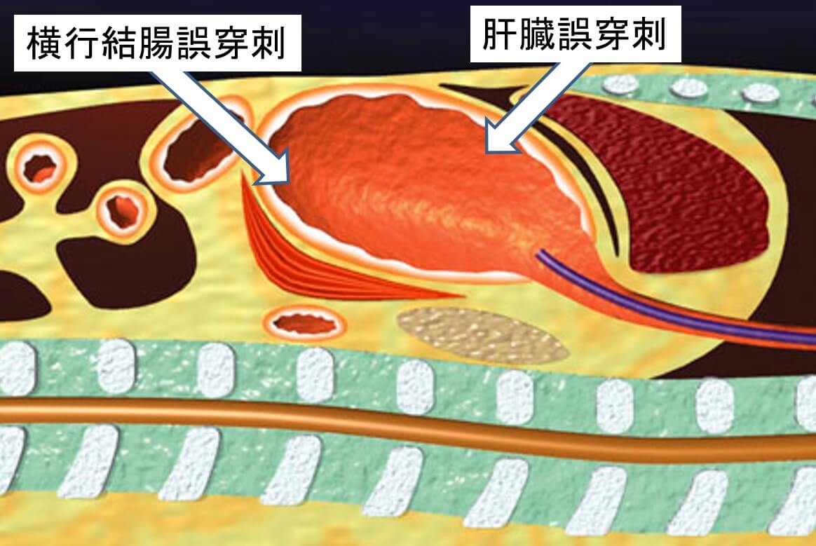 図３　他臓器誤穿刺