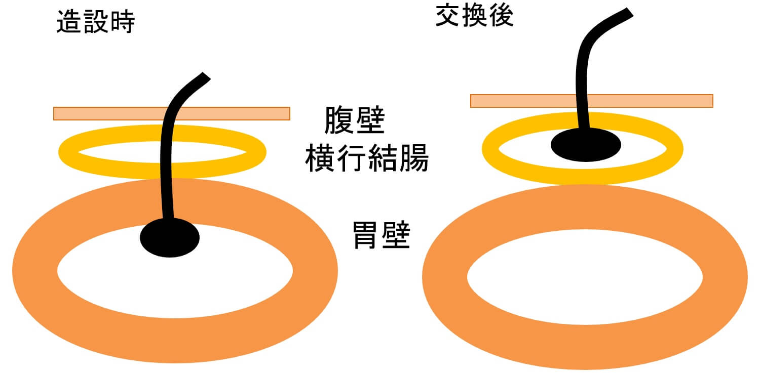 図4　胃瘻造設時横行結腸貫通