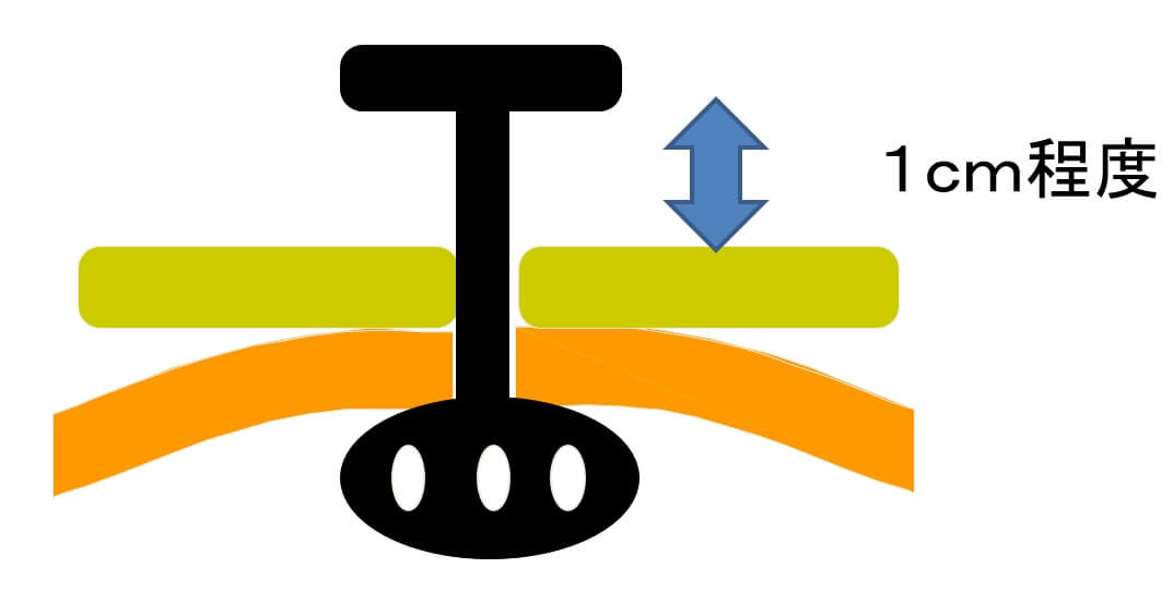 図１　外部ストッパーと皮膚間には遊びが必要