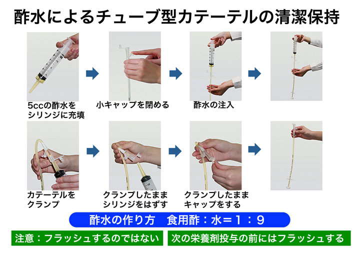 酢水によるチューブ型カテーテルの清潔保持