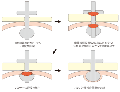 図１　発生機序