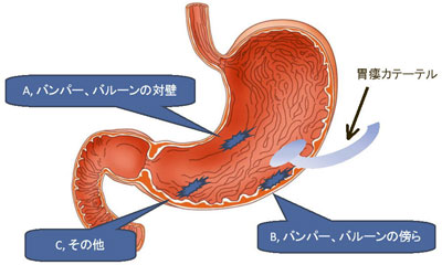図１　胃潰瘍の発生部位