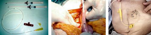 図3 開腹術による穿刺式カテーテル空腸瘻造設術 needle catheter jejunostomy